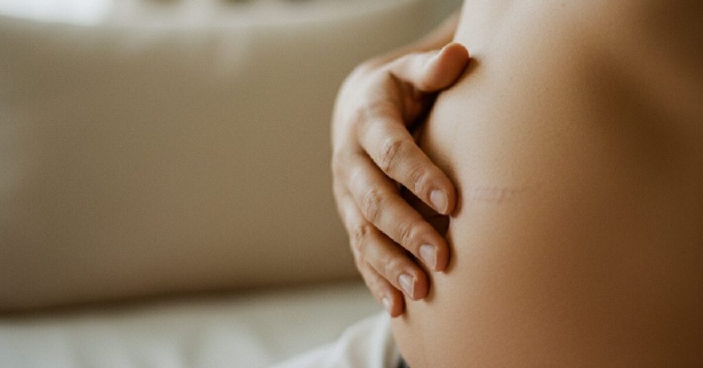 Cicatrizes Cesárea: 5 Erros Comuns e Como Cuidar em 2026 - imagem 1