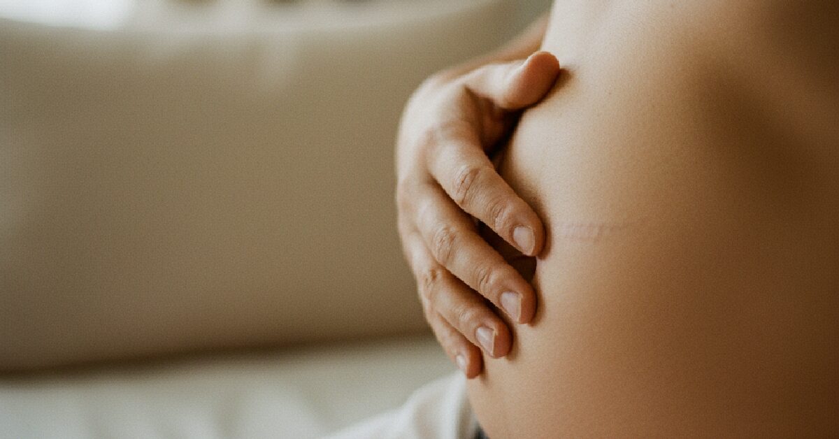 Cicatrizes Cesárea: 5 Erros Comuns e Como Cuidar em 2026